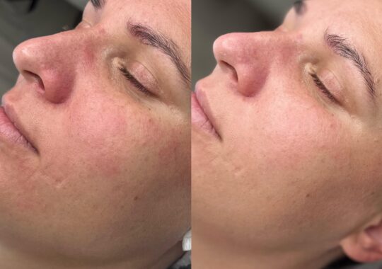 Hydrafacial