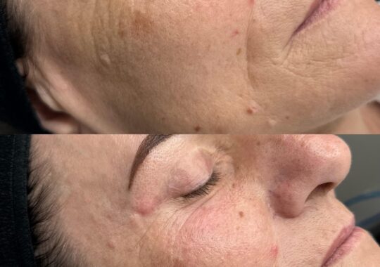 Hydrafacial