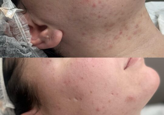 hydrafacial